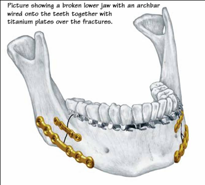 Fractures of the Mandible / Lower Jaw7